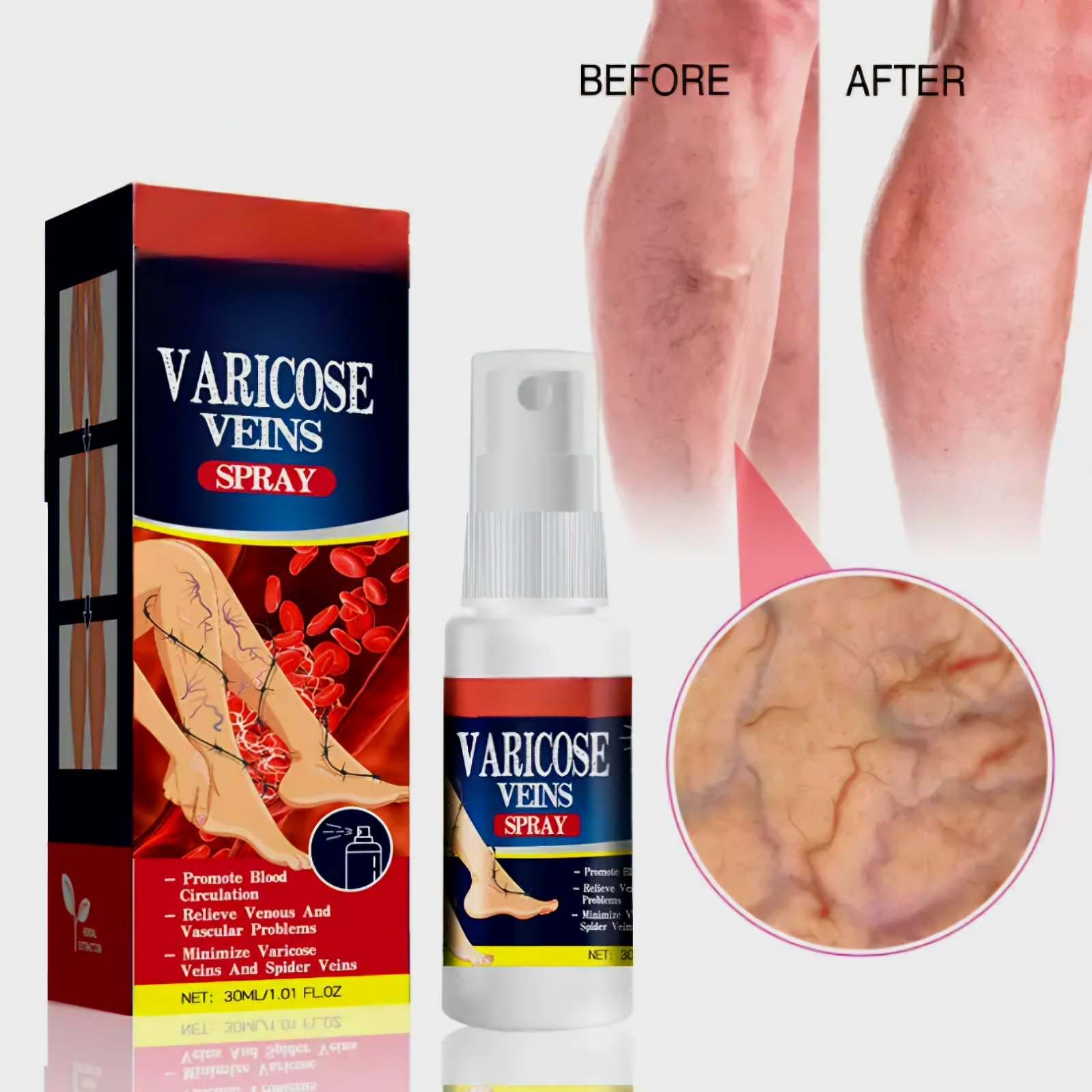 Varicose veins 1
