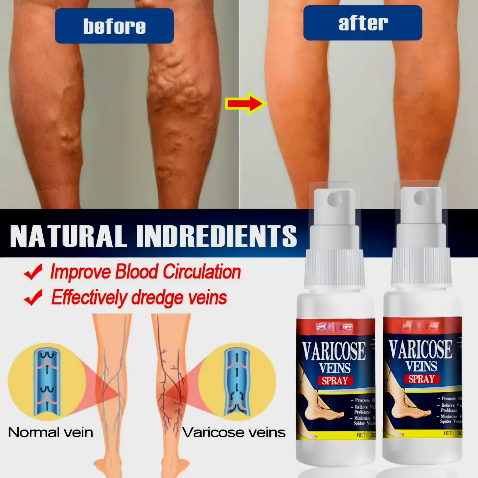 Varicose veins 2