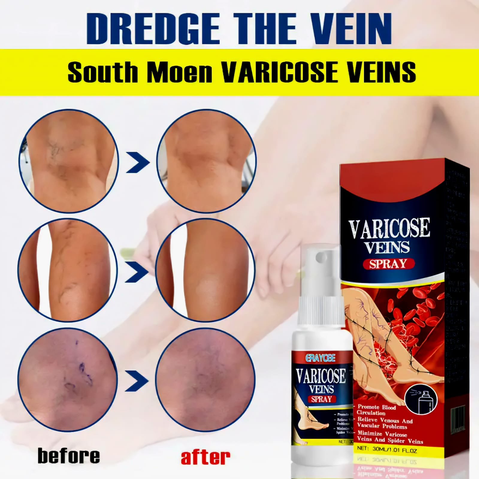 Varicose veins 4